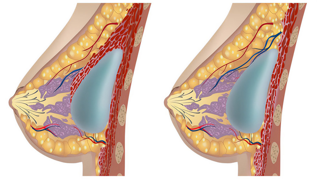 augmentation mammaire par implants Tunisie