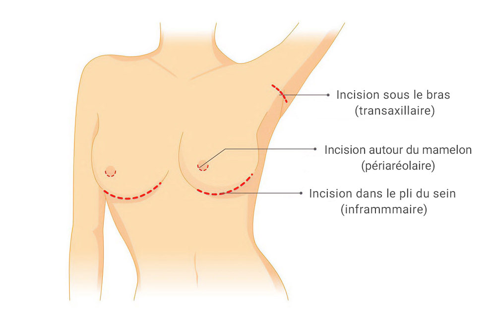 TECHNIQUES D’INCISION