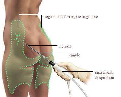 augmentation des fesses par lipofilling