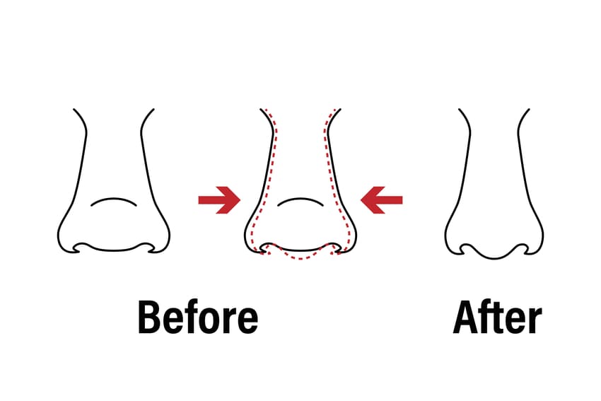 rhinoplastie ethnique tunisie