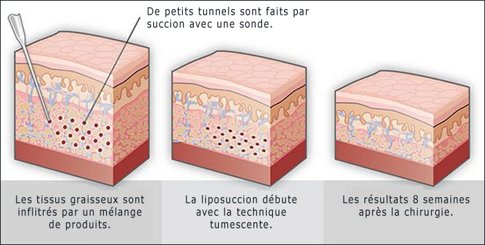 La liposuccion tumescente pour réduire les douleurs et saignements