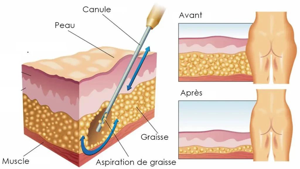 combien-peut-on-retirer-litres-de-graisse