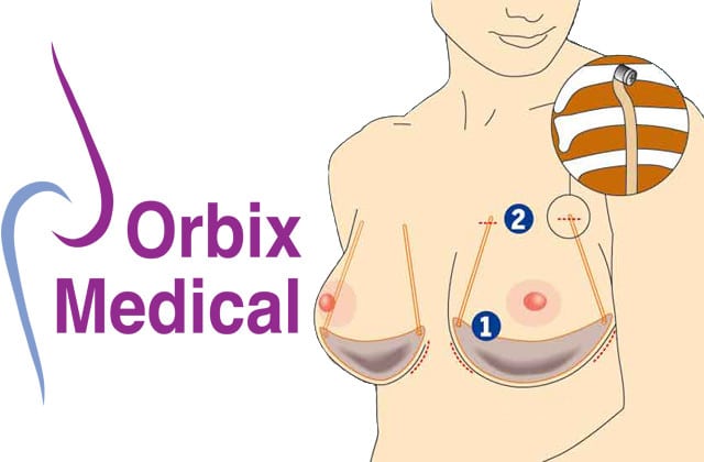 Un soutien-gorge pour révolutionner les opérations mammaires
