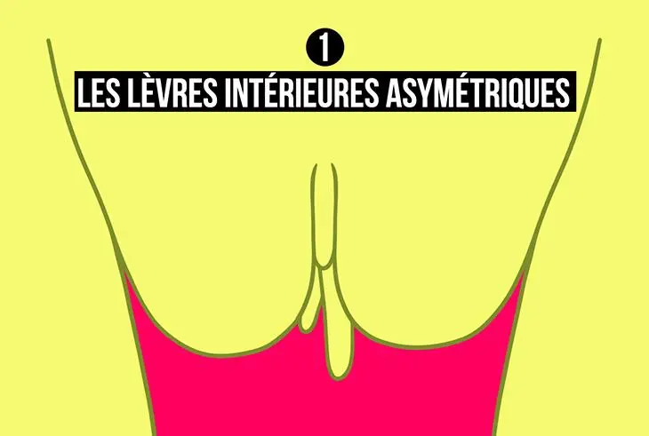 Levres-interieures-asymetriques