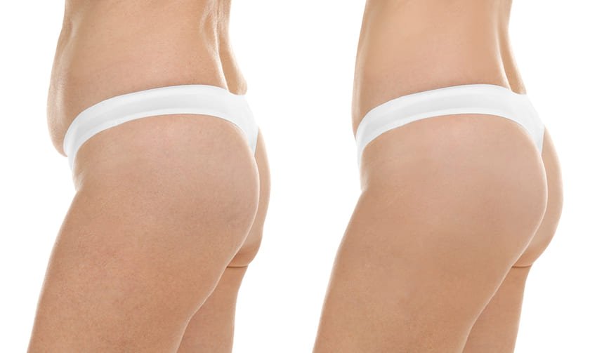 prix liposuccion cuisse Tunisie pas cher