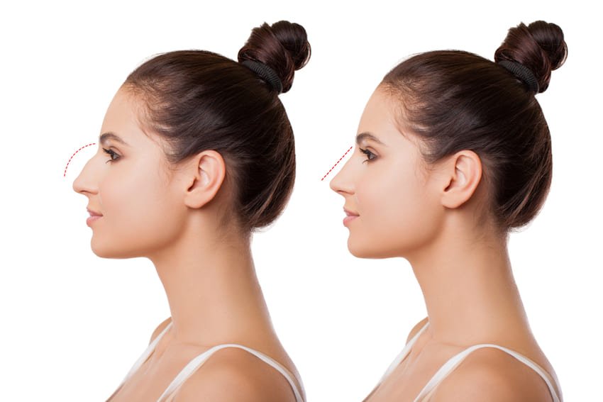 prix chirurgie nez Tunisie