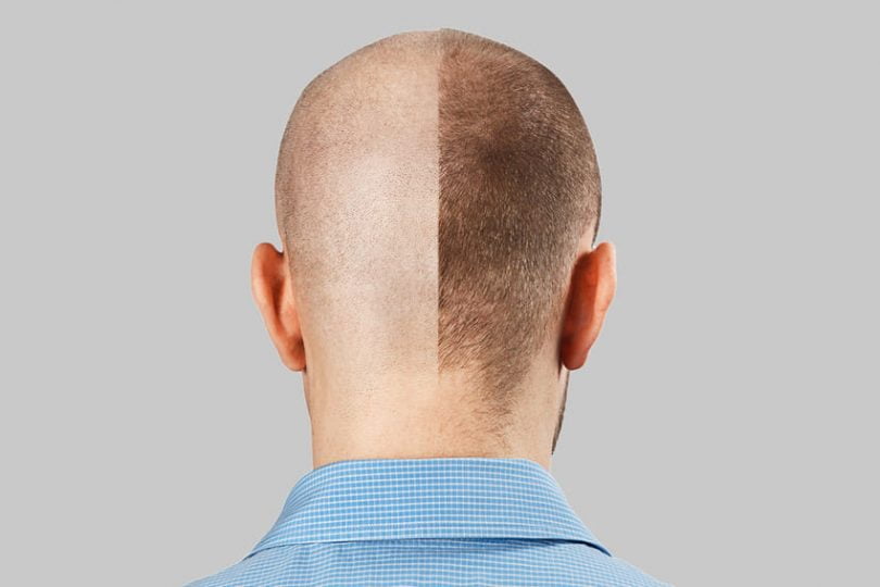 prix greffe cheveux Tunisie