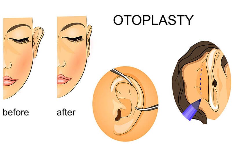prix otoplastie