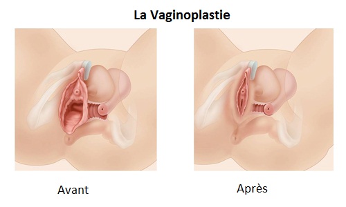 Prix Vaginoplastie Tunisie 